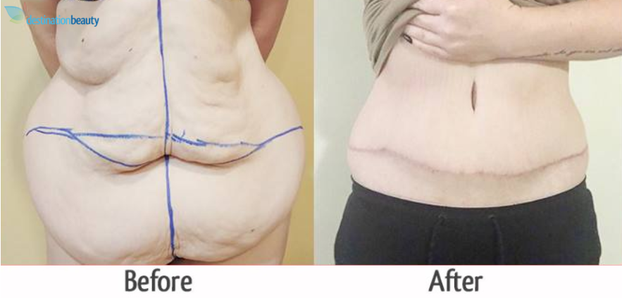 Kayla�s extended tummy tuck in Bangkok! Removing excess